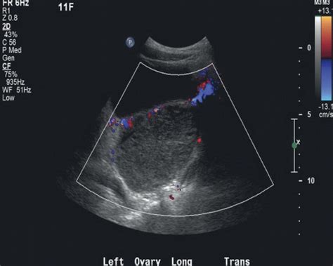 Ovarian Torsion | Radiology Key