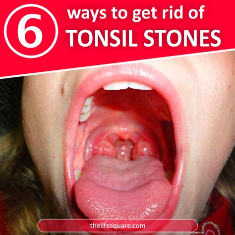 Pin on Tonsil Stones