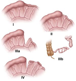 Intestinal atresia 장폐쇄증 : 네이버 블로그