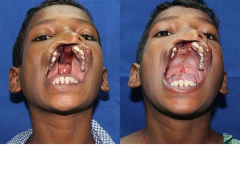 FREE CLEFT LIP AND PALATE SURGERY IN DELHI: A 12 years with a wide cleft