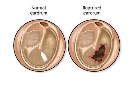 A perforated eardrum is a tear or hole in the ear's tympanic membrane . A perforated eardrum is ...