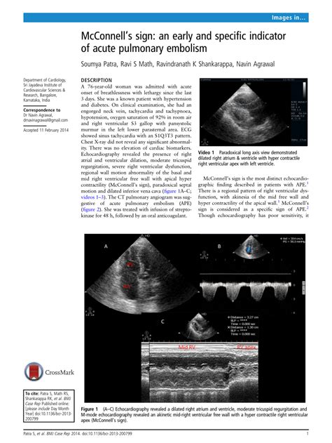 (PDF) McConnell's sign: An early and specific indicator of acute ...