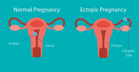 Ectopic Pregnancy: Causes, Sypmtoms, Diagnosis-Treatment » How To Relief