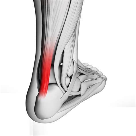 Pain in the Achilles Tendon | Center Grove Foot & Ankle Care