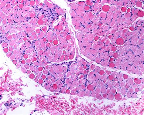 Muscular Dystrophy Prognosis - Rare Disease Advisor