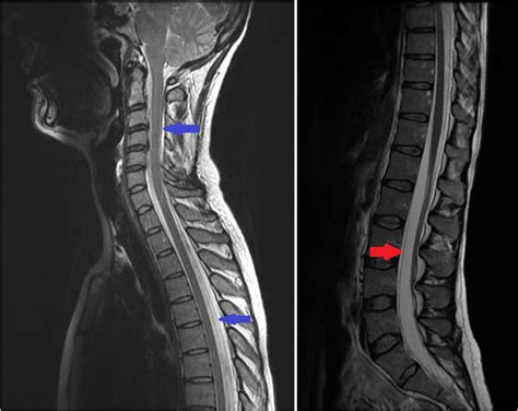 T2-weighted magnetic resonance imaging (saggital section) showing... | Download Scientific Diagram