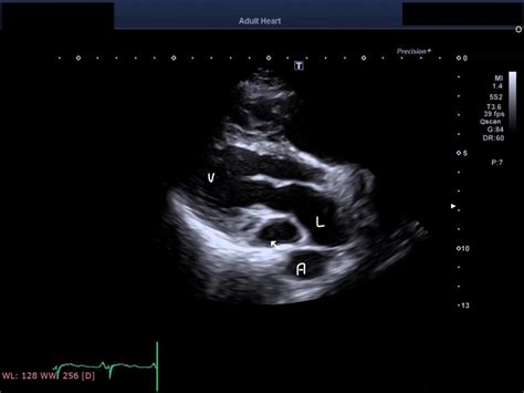 Point-of-Care Ultrasound to Detect Dilated Coronary Sinus in Adults ...