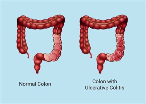 Ulcerative Colitis Symptoms, Causes, Treatment And Cure