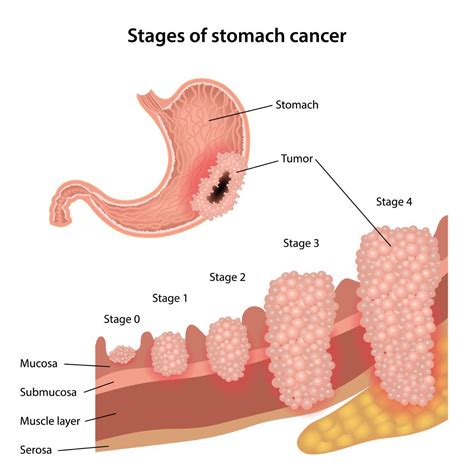 GERD or Stomach Cancer? Symptoms to Watch Out! - Women Fitness