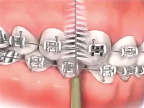 How to clean your teeth with braces - Sherway Gardens Dental Centre