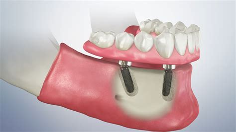 Implant-Supported Dentures | Dentist Aurora, CO