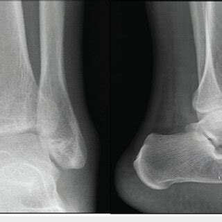 X-ray at presentation showing minimally displaced tibial plafond ...