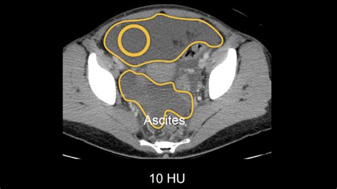 Abdominal CT: Attenuation • LITFL • Radiology library