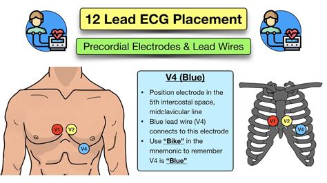 12 Lead ECG Placement: Diagram and Mnemonic for Limb and Precordial ...