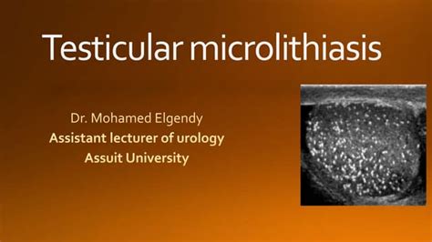 testicular microlithiasis simple.pptx