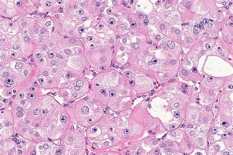 Renal Cell Carcinoma | Concise Medical Knowledge