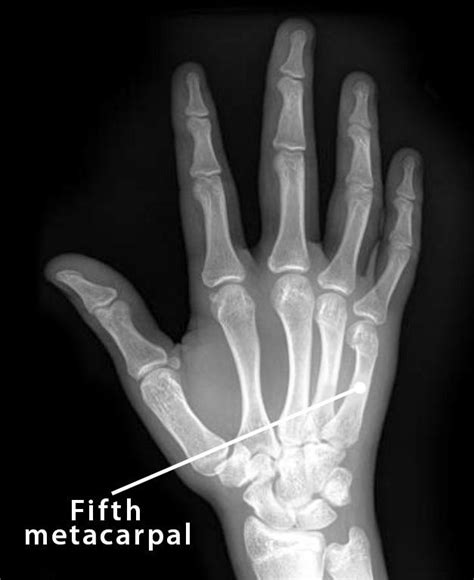 Fifth Metacarpal: Definition, Location, Anatomy, Diagram