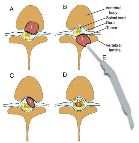 Spinal Tumor Treatment Services, मेडिकल सर्जरी सेवाएं in Chembur ...