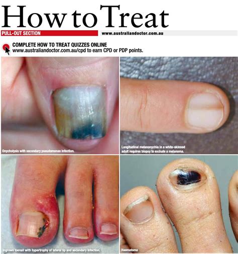 Discover more than 145 different kinds of nail diseases latest - ceg.edu.vn