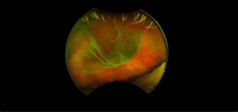 California - Retinal Break and Retinal Detachment, RG