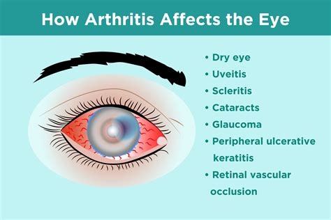 Common Eye Diseases – Glaucoma Symptoms, Causes, and Treatments | Ponirevo