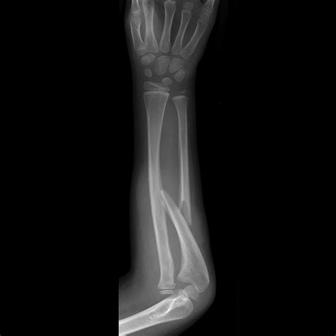 Monteggia fracture-dislocation | Image | Radiopaedia.org