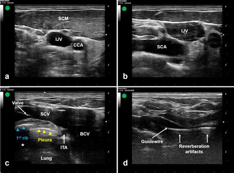 Ultrasound-guided subclavian vein catheterization using the long-axis ...