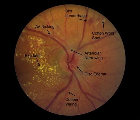 Moran CORE | Hypertensive Retinopathy