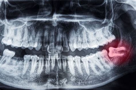 Are Your Wisdom Teeth Causing You Pain? | Alburquerque, NM
