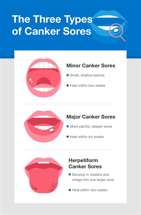 Bad Canker Sores