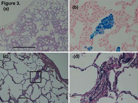 Figure3.Video-assisted surgical lung biopsy findings from November... | Download Scientific Diagram