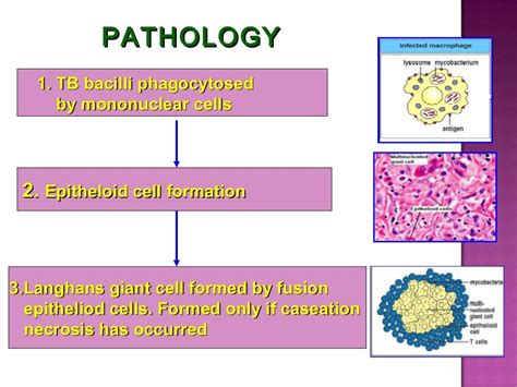 tuberculosis of spine