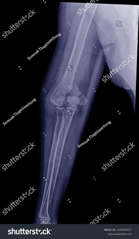 Xray Images Forearm Bones Showed Fracture Stock Photo 2228780917 | Shutterstock