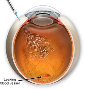 Avastin Eye Injection : Side Effects Of Avastin Injections In The Eye - creditosgrazy