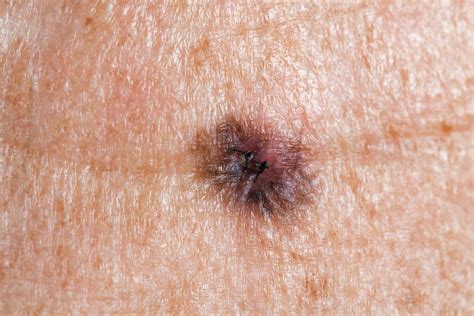 Skin Cancer Symptoms: How to Check for Moles | Reader’s Digest