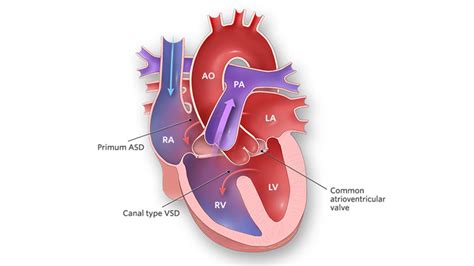 Congenital Heart Defects Facts About Atrioventricular, 59% OFF