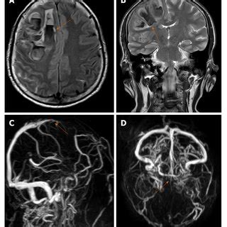 A 61-year-old male with Dural venous thrombosis. A and B: Axial and ...