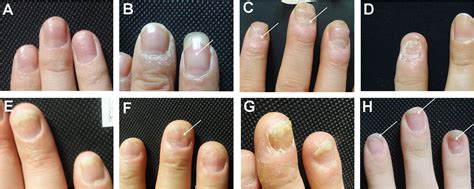 Frontiers | Predicting the Risk of Psoriatic Arthritis in Plaque Psoriasis Patients: Development ...