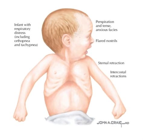 intercostal retractions - USA News Collections