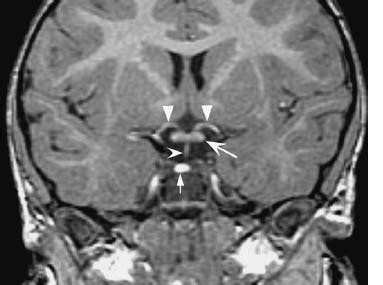 Optic Nerve | Radiology Key