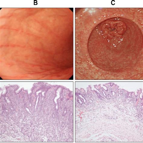 Kimura-Takemoto classification of chronic atrophic gastirits: (A)... | Download Scientific Diagram