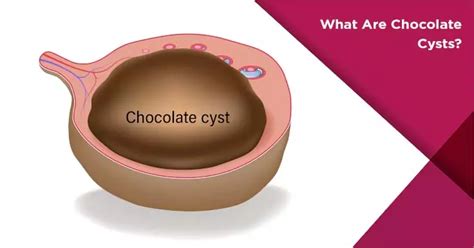 Chocolate Cysts: Essential Information for Every Woman | Nova IVF Fertility