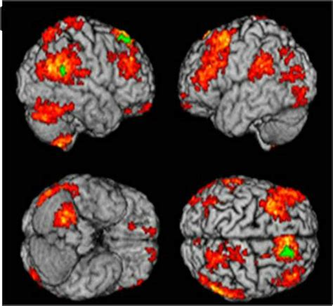 A brain scan to tell if you're depressed – and what treatment is needed