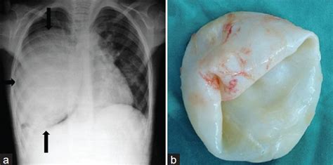 Lung hydatid cyst in a 10-year-old boy. a) Chest radiograph shows a... | Download Scientific Diagram