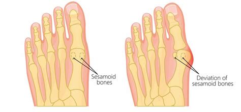 Big Toe Knuckle Pain [Causes, Symptoms & Best Treatment]