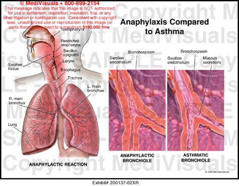 Anaphylaxis Compared to Asthma Medical Illustration Medivisuals