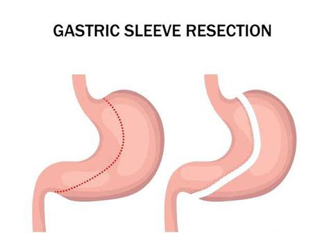 Gastric resection - MEDizzy