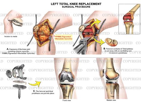 Total Left Knee Replacement - PVNS (Pigmented villonodular synovitis) – Medical Art Works