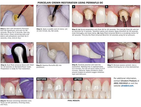 Achieving Optimal Strength and Retention for Ceramic Crown Restorations ...