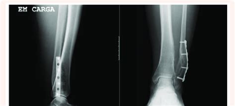 X-Ray after removing two trans-syndesmotic screws. | Download Scientific Diagram